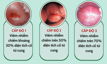 bac-si-chia-se-nhung-su-that-co-the-ban-chua-biet-ve-viem-lo-tuyen