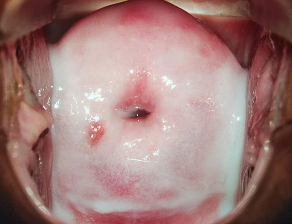 nấm Candida phủ trắng cổ tử cung