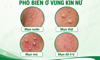 canh-bao-noi-mun-vung-kin-nu-la-gi-nhan-biet-som-benh-ly-nguy-hiem-tiem-an