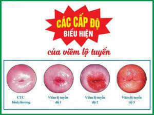 Bảng giá chữa viêm lộ tuyến cổ tử cung chị em không thể bỏ qua